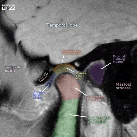 Temporomandibular Joint (TMJ) – MRI Anatomy Breakdown