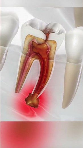 An Overview of Abscessed Teeth: Causes, Symptoms, and Treatment