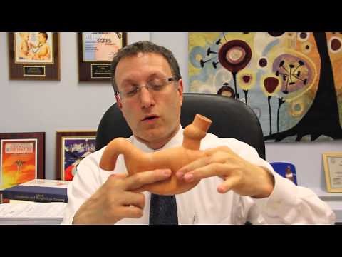 Sleeve Gastrectomy Operation