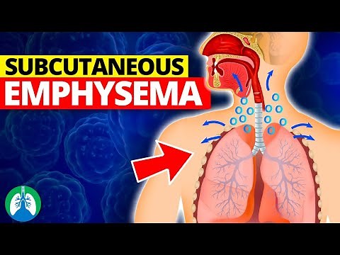 Subcutaneous Emphysema (Medical Definition) | Quick Explainer Video