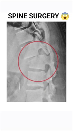 Shocking Spine X-Ray 😱 Metal Screws Inside Human Body | Spine Surgery Explained