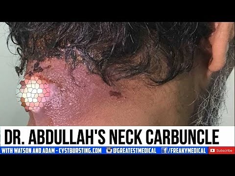 Dr Abdullah's Neck Carbuncle! Furuncles and Boils!