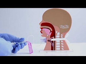 Tracheostomy PAM: Cuff Deflation