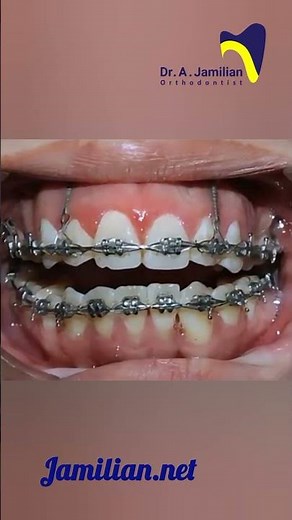 The Miracle of Orthodontics: Transforming Smiles, Changing Lives! #dentist #orthodontics #bracs