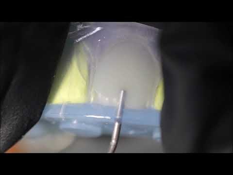 Flowable Injection Technique