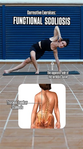 Thoracolumbar lordosis refers to an excessive inward curvature at the junction of the thoracic and lumbar regions of the spine. This condition often arises from prolonged sitting, weak core and gluteal muscles, and tight hip flexors or spinal extensors. Posture correction exercises are crucial for restoring alignment. A balanced program includes core strengthening, glute activation, spinal mobility work, and stretches for the hip flexors and lower back. Regular practice helps relieve discomfort,