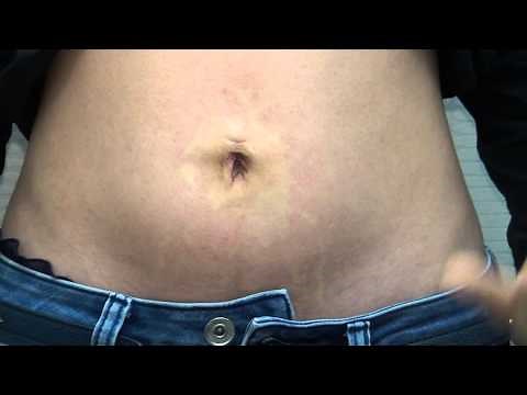 高須クリニック 出べそ（臍ヘルニア）修正手術④ 手術直後の立っている映像 術後の腫れ、経過、痛み、ダウンタイムについて