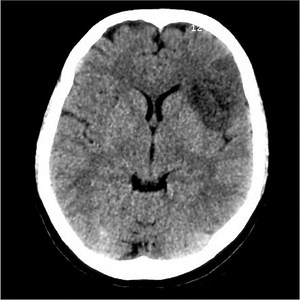 Fogging phenomenon (cerebral infarct) | Radiology Reference Article | Radiopaedia.org