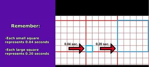 How to Interpret (Analyze) an ECG Rhythm Strip