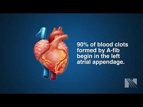 Watchman Procedure for Left Atrial Appendage Occlusion (LAAO)