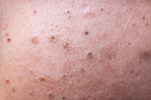 Dr. Pimple Popper's 25 Most Satisfying Blackhead Videos