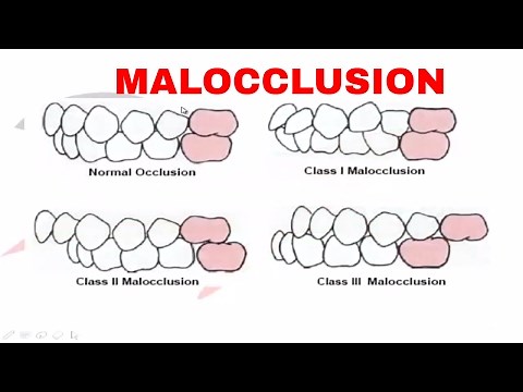 Malocclusion : Part I