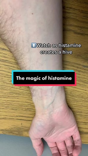 Understanding the Magic of Histamine | Allergies Explained