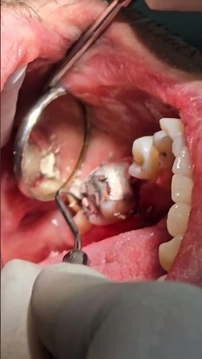 How is an amalgam filling procedure? amalgam build up |