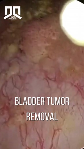 Removing a bladder tumor. #docdrew #docdrewuro #urology #urologist #bladdertumor #bladdercancer #turbt | Doc Drew Valdez - Urology