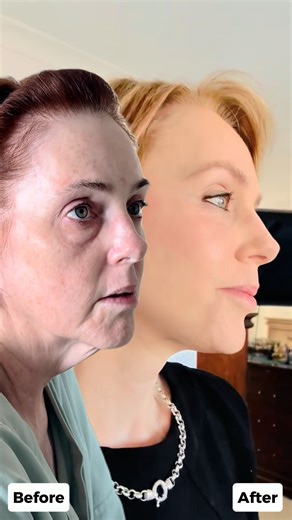 29K views · 361 reactions | Her turkey neck is gone—what a...