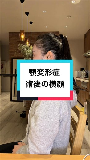 顎変形症 術後の横顔を見せるオールバックポニーテールの変化