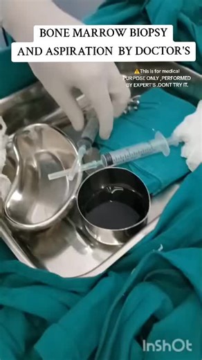 BONE MARROW BIOPSY AND ASPIRATION PROCEDURE #medicalvideos #doctorsoftiktok #bonemarrowbiopsy #bonemarrowaspiration #medicalstudent #familyphysician #fypage #fypシ #trending #viraltiktok #medicine #procedure A bone marrow biopsy is a medical procedure where a small sample of bone marrow is extracted and examined to diagnose and monitor various blood and bone marrow disorders. It involves taking a sample of the bone marrow, the spongy tissue inside bones where blood cells are produced, for laborat