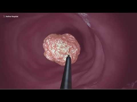 Laser Surgery for Stones