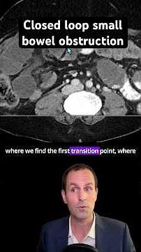 Abdominal CT Tutorials - Closed loop small bowel obstruction