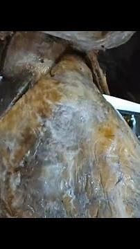 Sinuses of the Pericardium