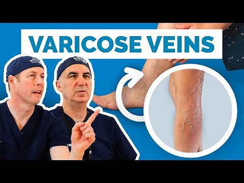Varicose Veins Explained: Causes, Symptoms, and Treatments