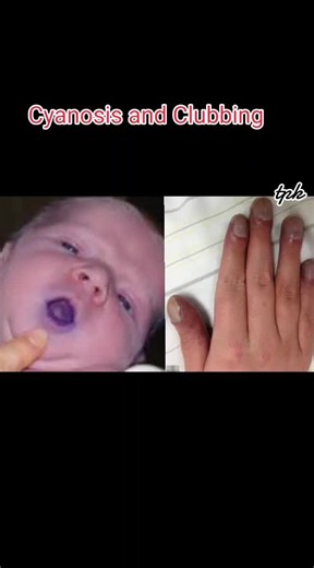 Understanding Cyanosis and Clubbing: Causes and Symptoms Explained