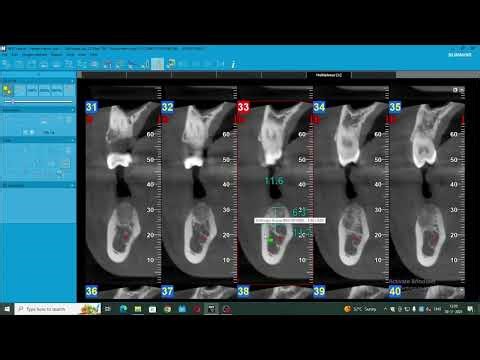 Implant Planning made Easy - CBCT Implant planning 46 region..