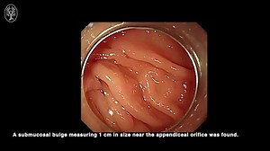 16K views · 143 reactions | Case of the month no. 1: “Endoscopic transcecal appendectomy” by Xiang-lei Yuan, Onpan Cheung, Jiang Du et al. A 53-year-old woman was referred to the hospital after a 1-cm submucosal bulge near the appendiceal orifice was incidentally found during a colonoscopy. […] Find the full article and video here: https://doi.org/10.1055/a-0889-7289 | Endoscopy | Facebook