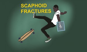 Scaphoid Fractures: how to not miss them - Pro doctor