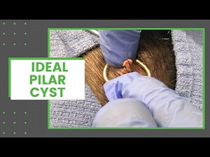 Ideal Pilar Cyst | Dr. Derm