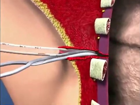 Chest Drains