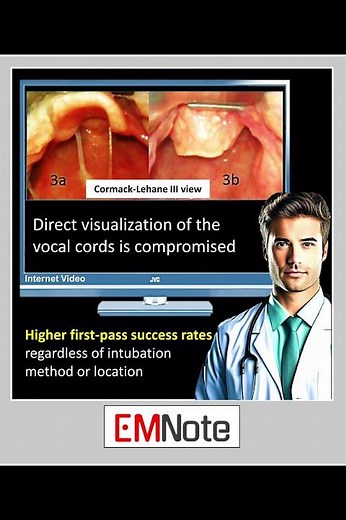 Bougie Assisted Intubation