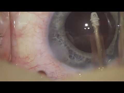 Routine Cataract Surgery