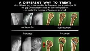 Understanding the Humeral Neck Fractures