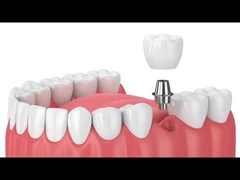 Dental Implant Procedure project