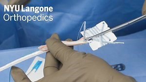 ACL Allograft Reconstruction Augmented with a Reinforced Bio-inductive Collagen Scaffold in the Setting of Multiligamentous Knee Injury and Lateral Meniscal Tear