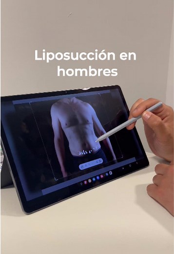 La liposucción no es solo para mujeres💪🏻 Si buscás eliminar grasa localizada en abdomen o flancos, la lipo masculina puede ser la solución😉 Para realizarla debes: ✅ Tener un peso estable y cercano al ideal ✅ Contar con buena elasticidad en la piel ✅ No fumar o estar dispuesto a dejarlo antes de la cirugía ✅ Tener expectativas realistas sobre los resultados Consultá sobre la agenda disponible y descubrí si es para vos🙌🏻