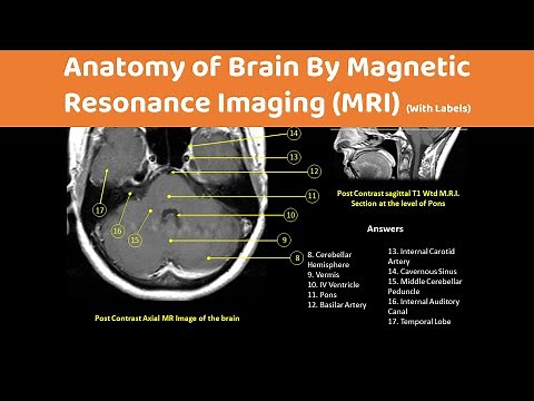 Brain Anatomy On an MRI (Magnetic Resonance Imaging) Scan