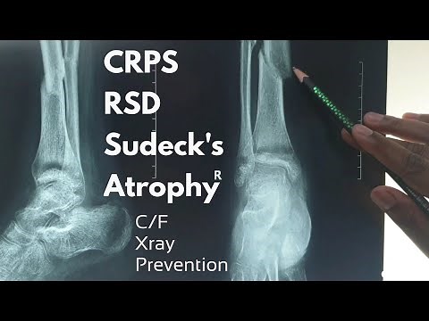 CRPS/RSD/Sudeck's Atrophy/Algodystrophy || C/F & Xray findings & prevention || Dr Abdullah Al Rafi