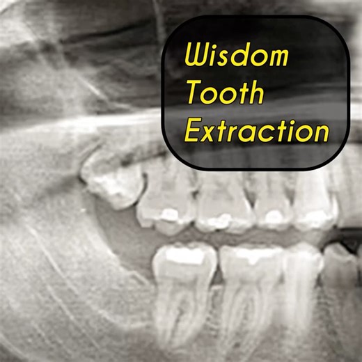 Upper Wisdom Tooth Extraction