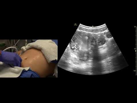 Transabdominal Pelvis Ultrasound Scanning Techniques