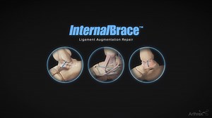 InternalBrace™ 2.0 Ligament Augmentation Repair