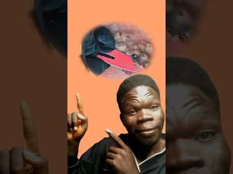 Deeper deep in to jigger: cleaning dirty #jigger #cleaning #trending #africa #satisfying #clean