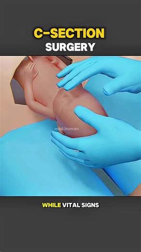 Understanding C-Section Surgery: A 3D Animation Guide