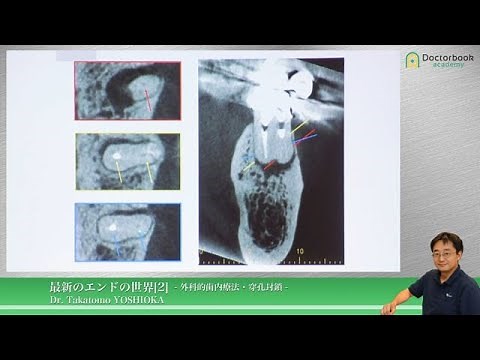 最新のエンドの世界 [2] - 外科的歯内療法・穿孔封鎖 - 吉岡 隆知先生