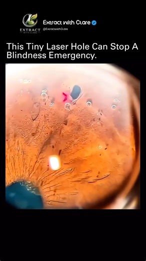 This Tiny Laser Saves Eyesight in Seconds 👁️⚡ (You Won’t Believe How!)