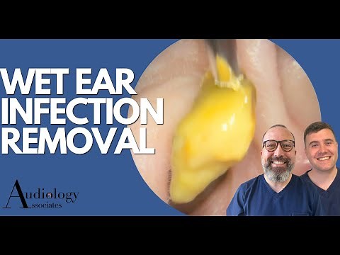 EAR INFECTION REMOVAL -EP870