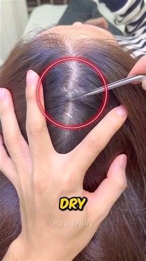 What's Actually Causing Your Dandruff? 😭