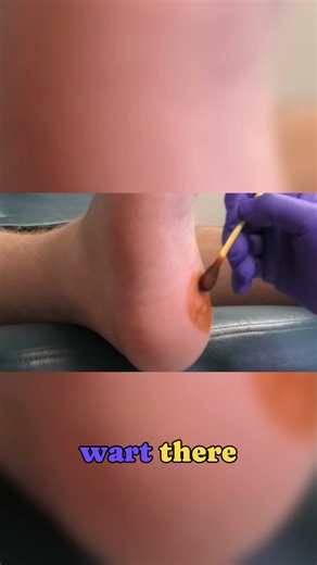 Wart Removal Procedure Highlights! 😲 #DrNailNipper #WartRemoval #WartTreatment #Podiatry #FootCare